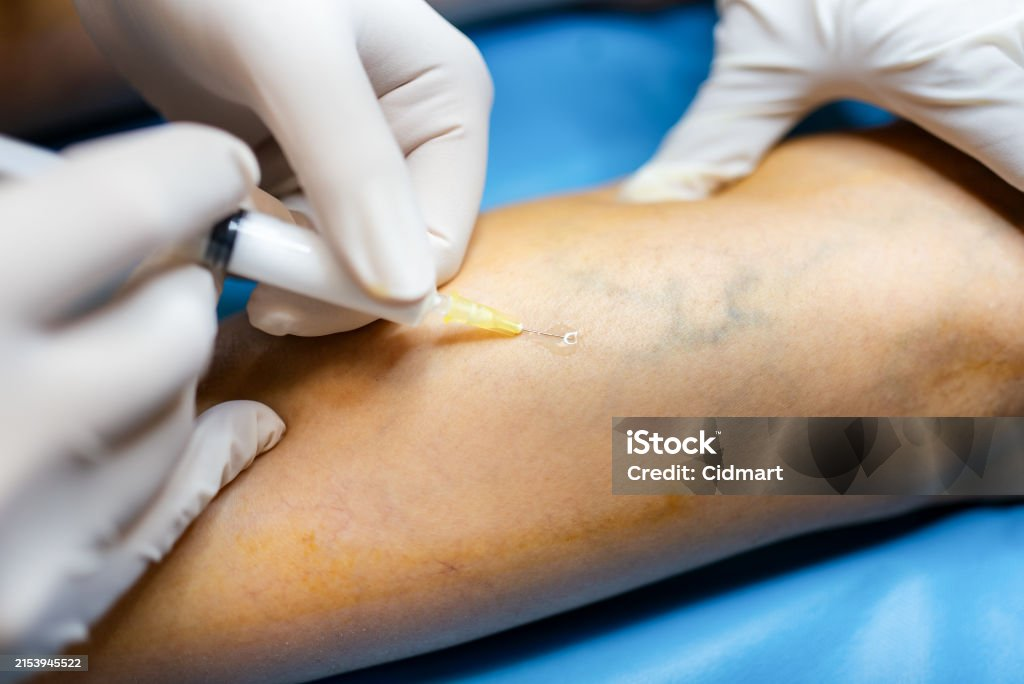 Uterine Fibroid Embolization (UFE)